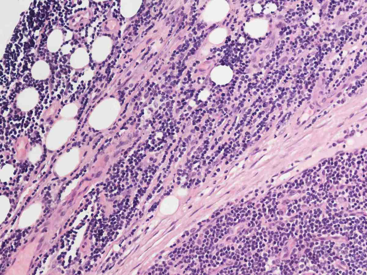 Lymph node 2010 HE 20X